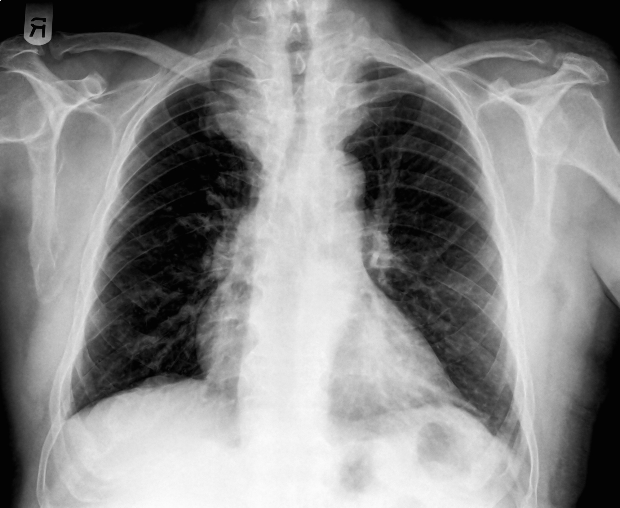 An Xray image of a human chest